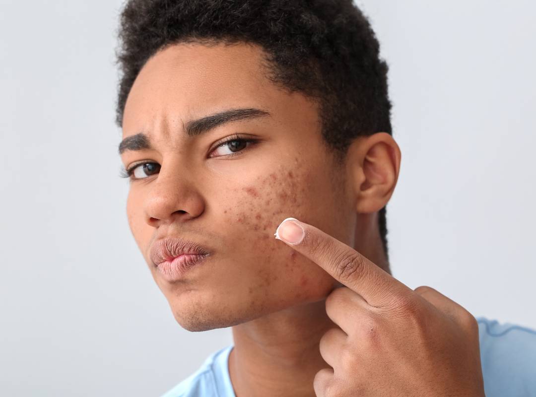 Acne Scars